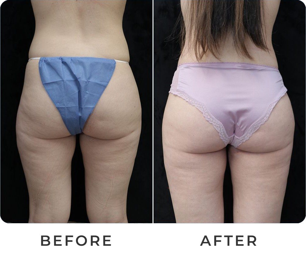 Liposuction with BBL before and after – Beverly Hills Physicians