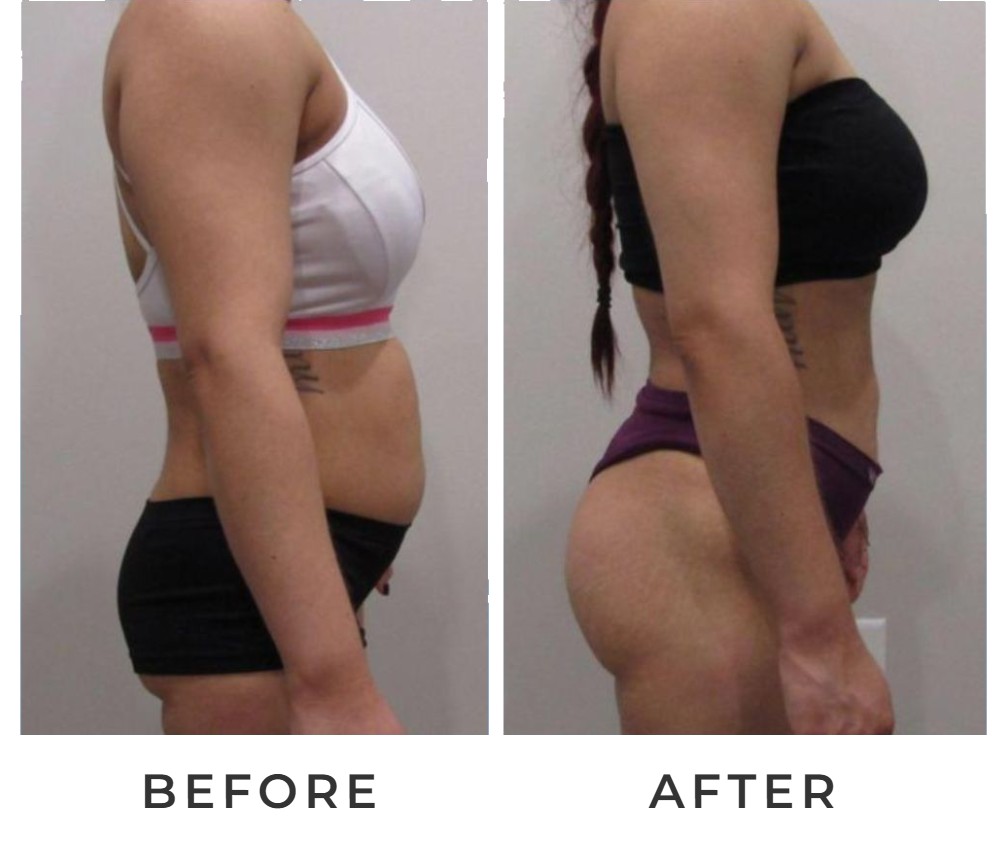 Liposuction with BBL before and after – Beverly Hills Physicians