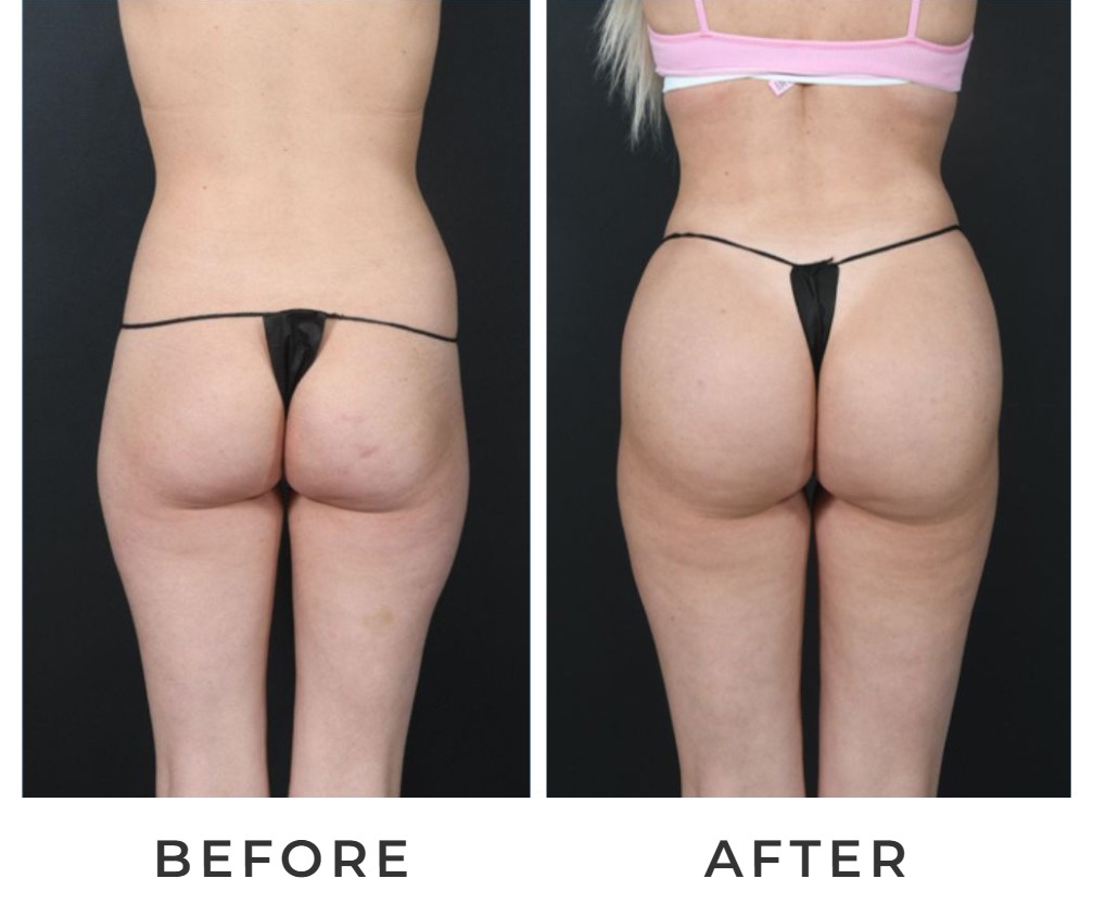 Liposuction with BBL before and after – Beverly Hills Physicians