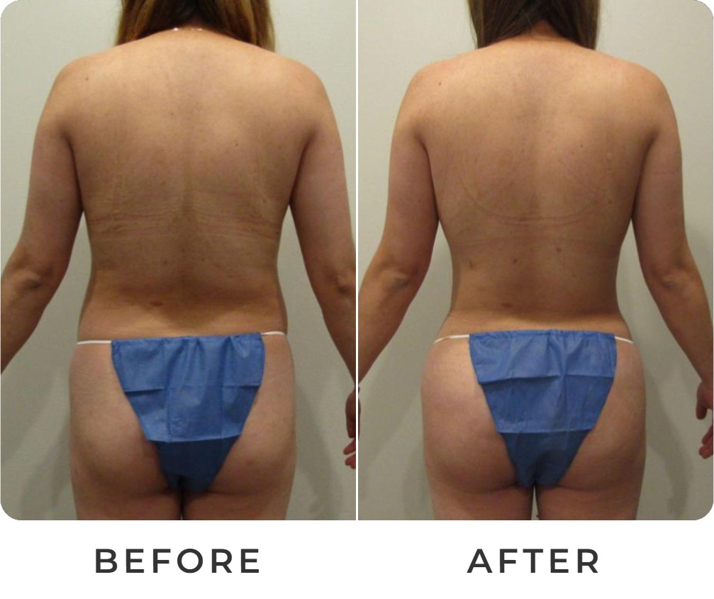 Liposuction before and after – Beverly Hills Physicians