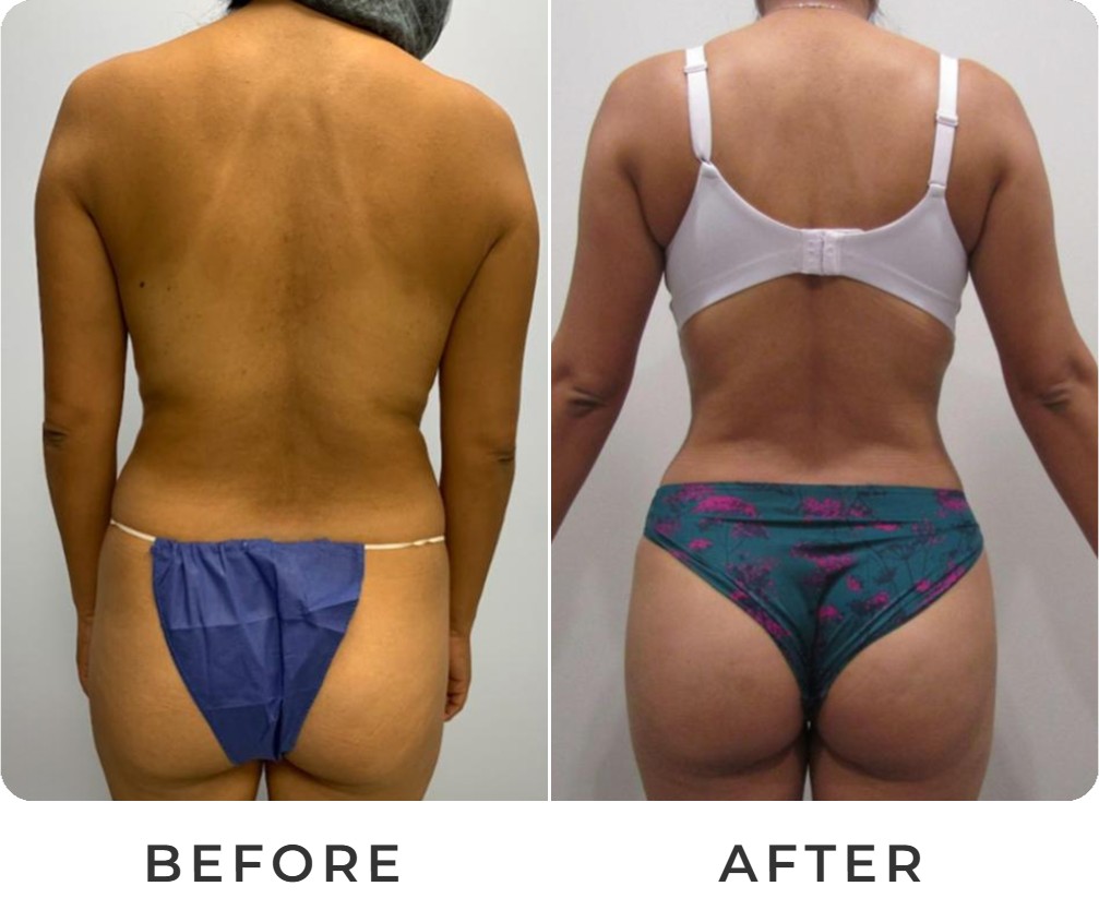 Liposuction before and after – Beverly Hills Physicians