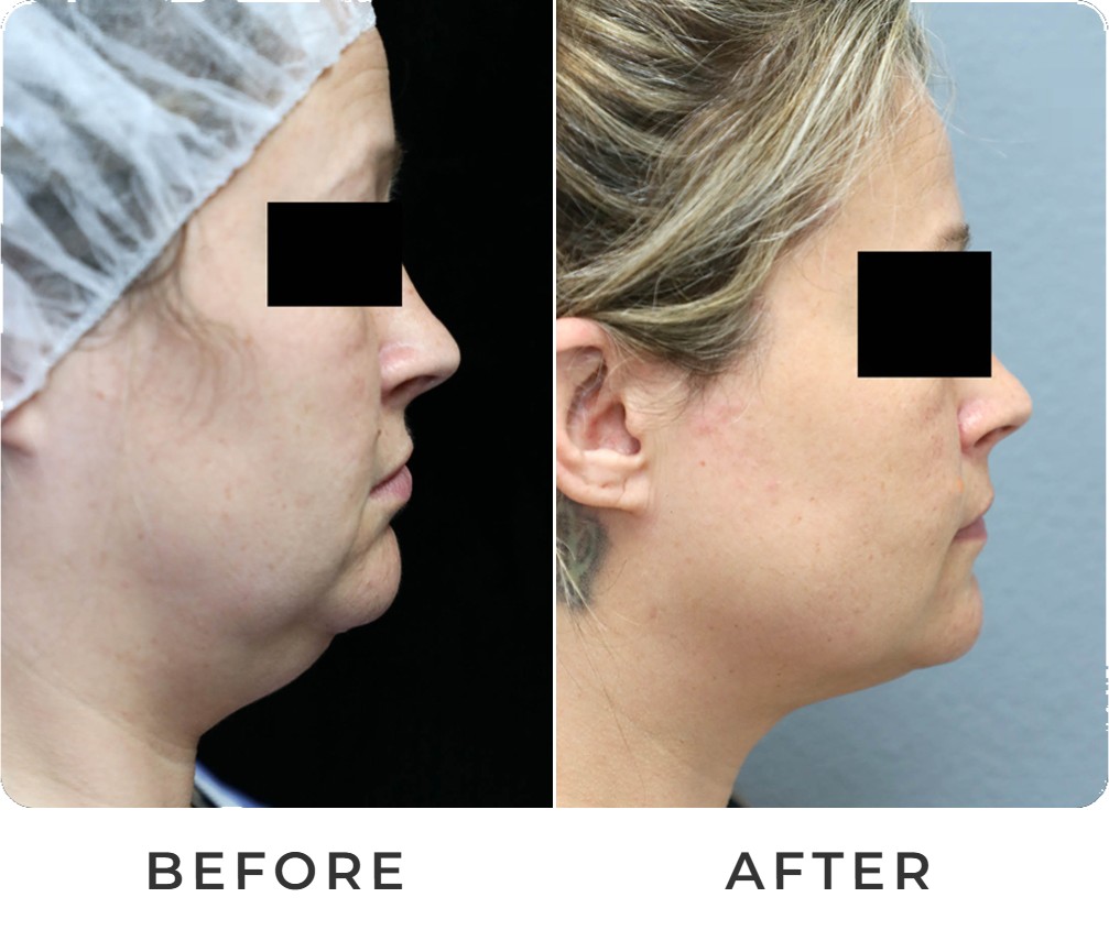 Liposuction before and after – Beverly Hills Physicians