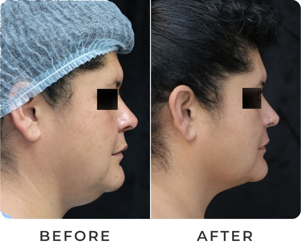 Liposuction before and after – Beverly Hills Physicians
