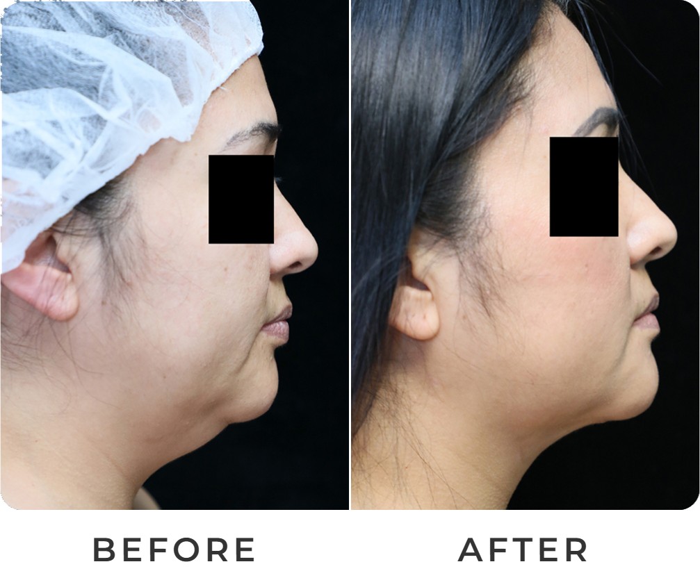 Liposuction before and after – Beverly Hills Physicians