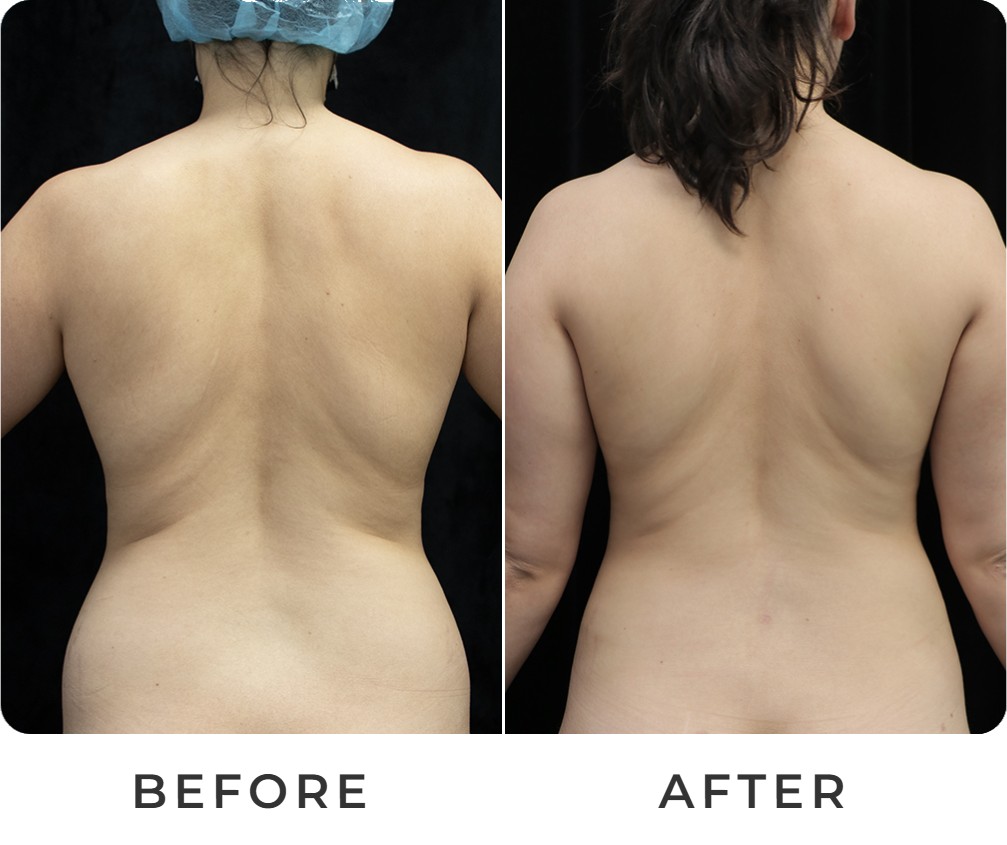 Liposuction before and after – Beverly Hills Physicians