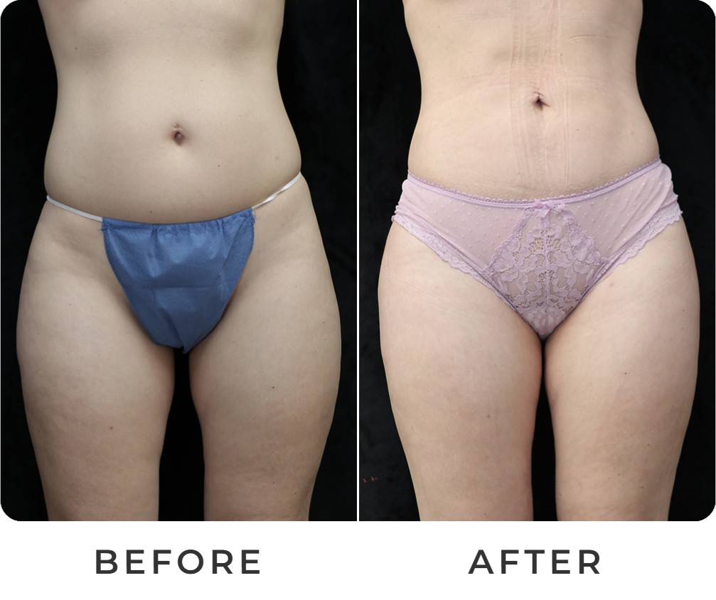 Liposuction before and after – Beverly Hills Physicians