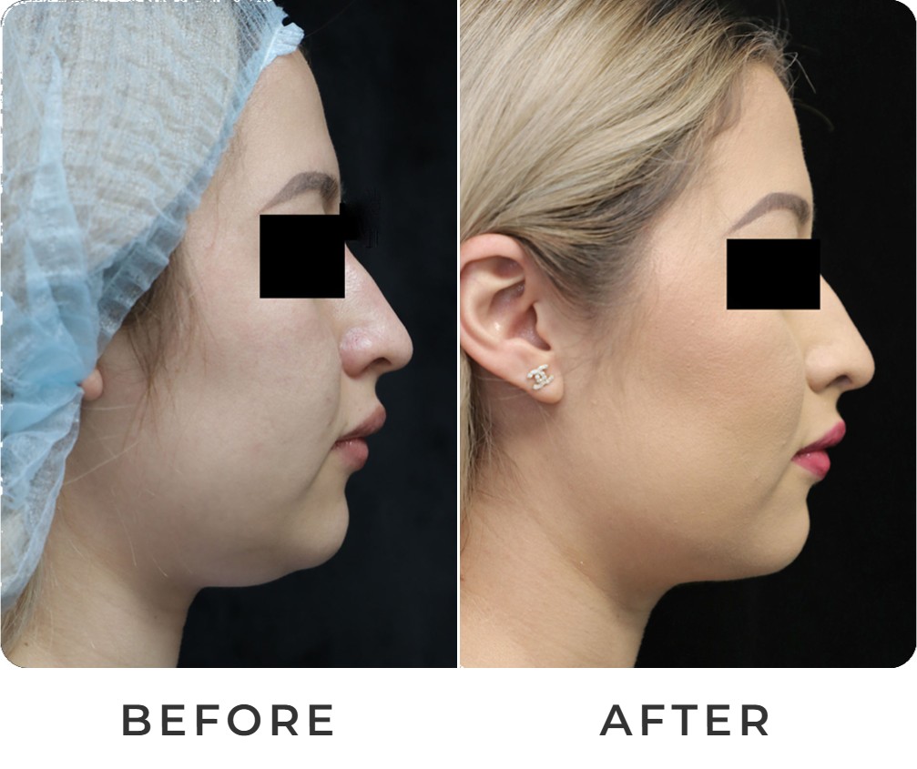 Liposuction before and after – Beverly Hills Physicians