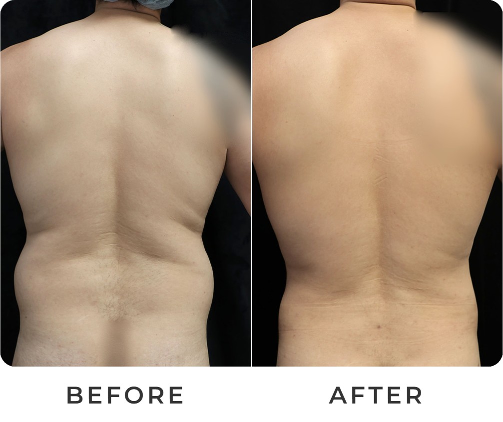 Liposuction before and after – Beverly Hills Physicians
