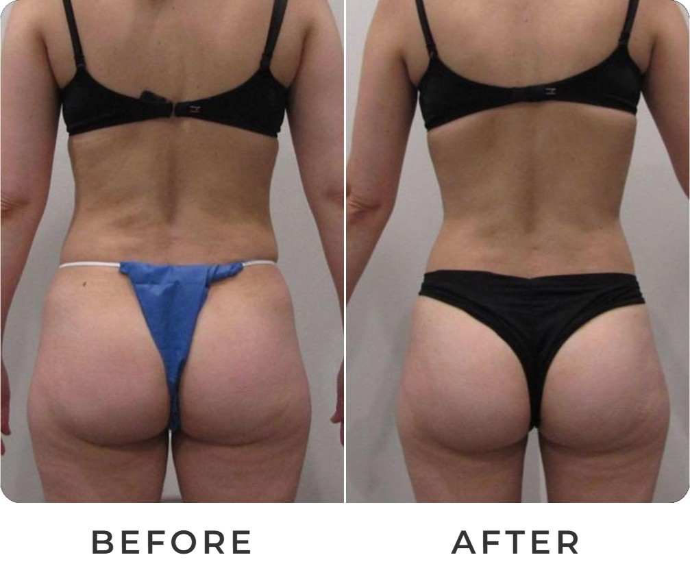 Liposuction before and after – Beverly Hills Physicians