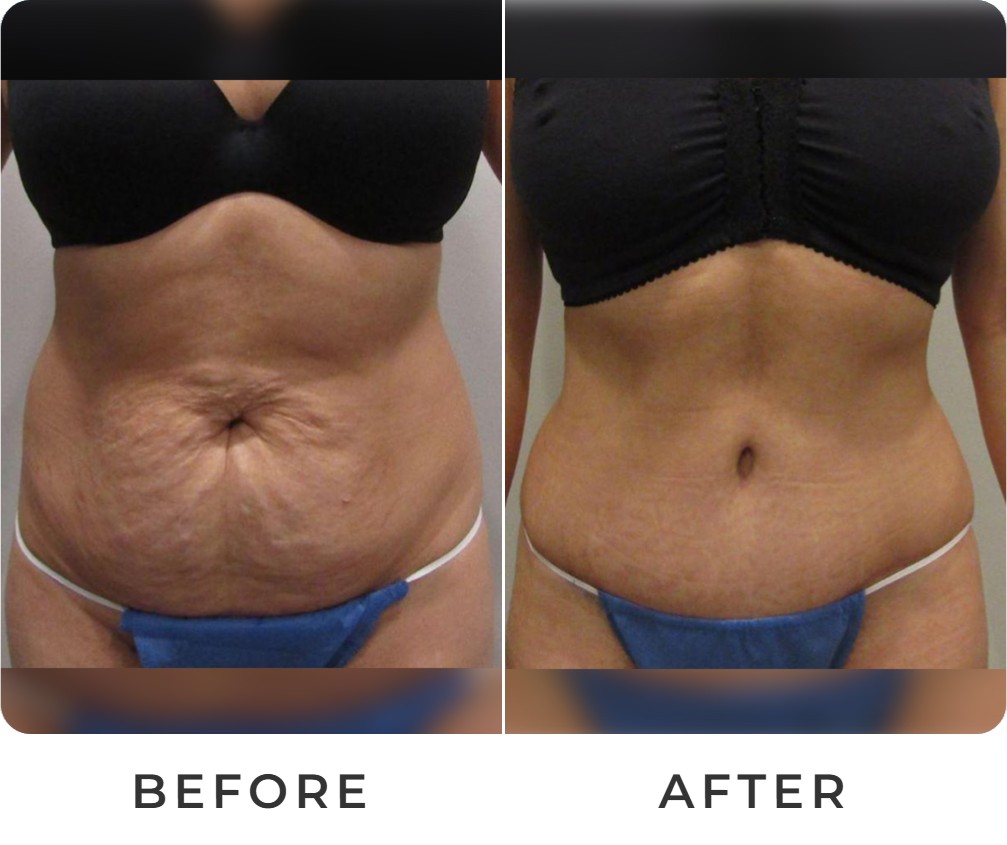 Tummy tuck before and after – Beverly Hills Physicians