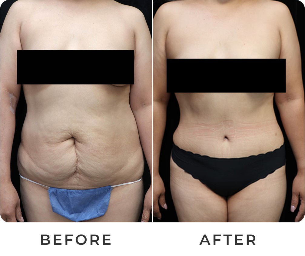Tummy tuck before and after – Beverly Hills Physicians