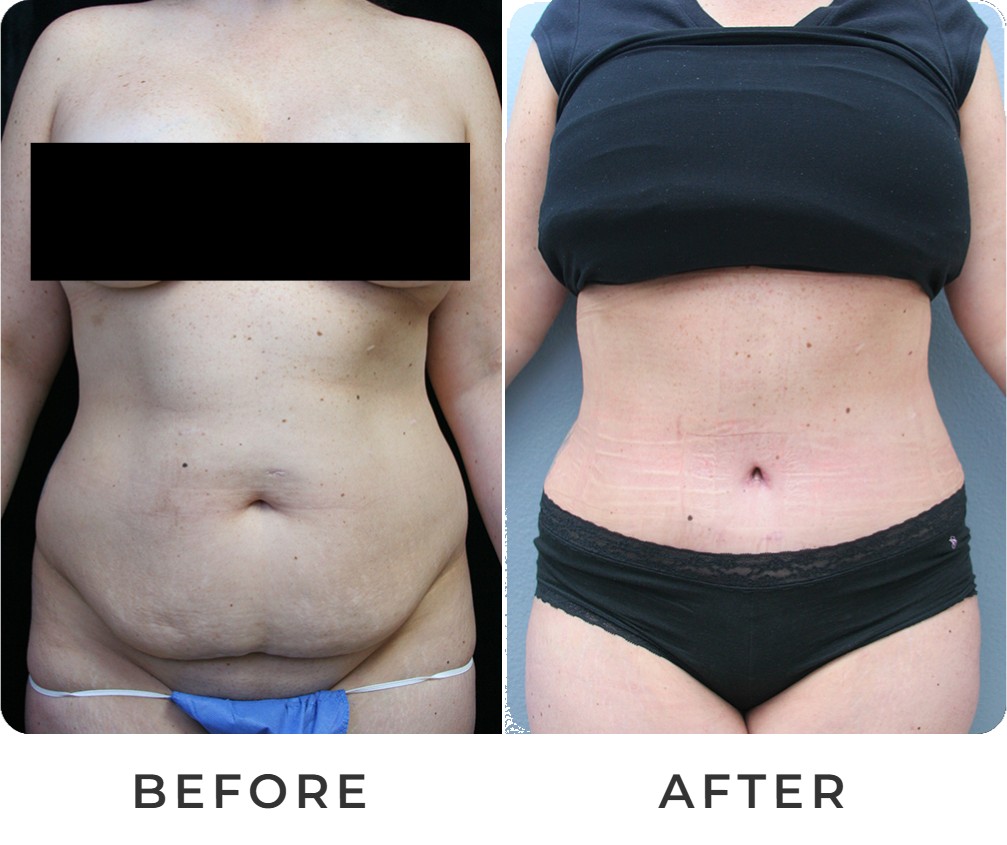 Tummy tuck before and after – Beverly Hills Physicians