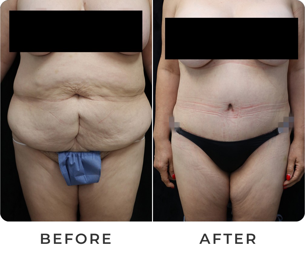 Tummy tuck before and after – Beverly Hills Physicians