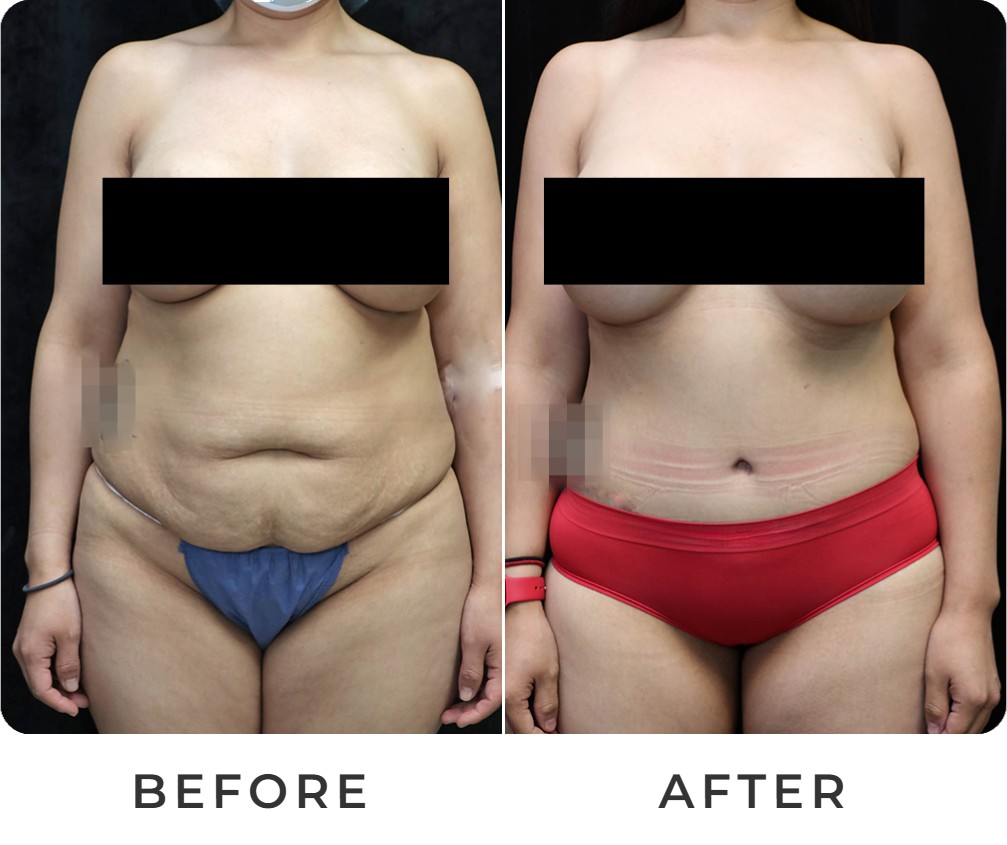 Tummy tuck before and after – Beverly Hills Physicians