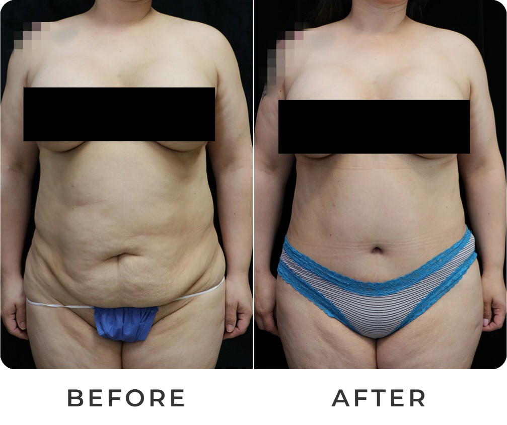 Tummy tuck before and after – Beverly Hills Physicians