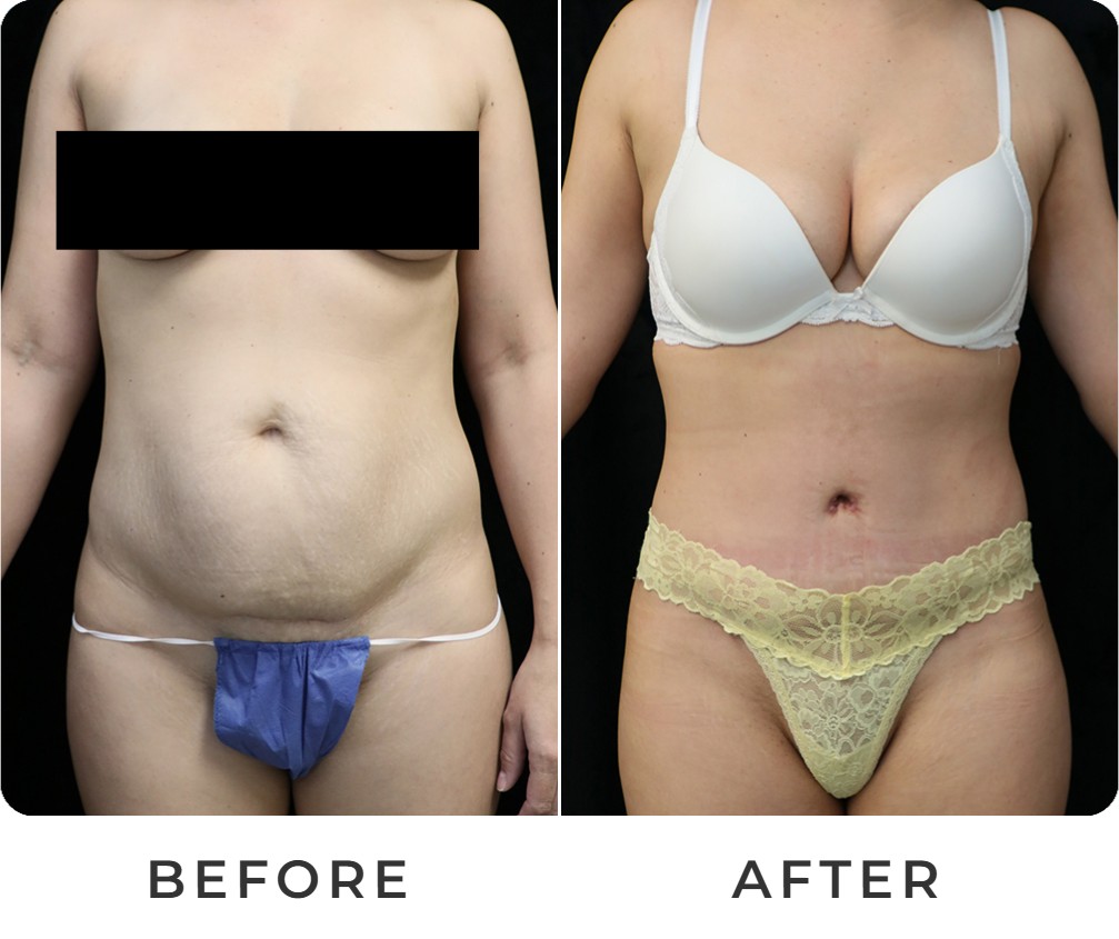 Tummy tuck before and after – Beverly Hills Physicians