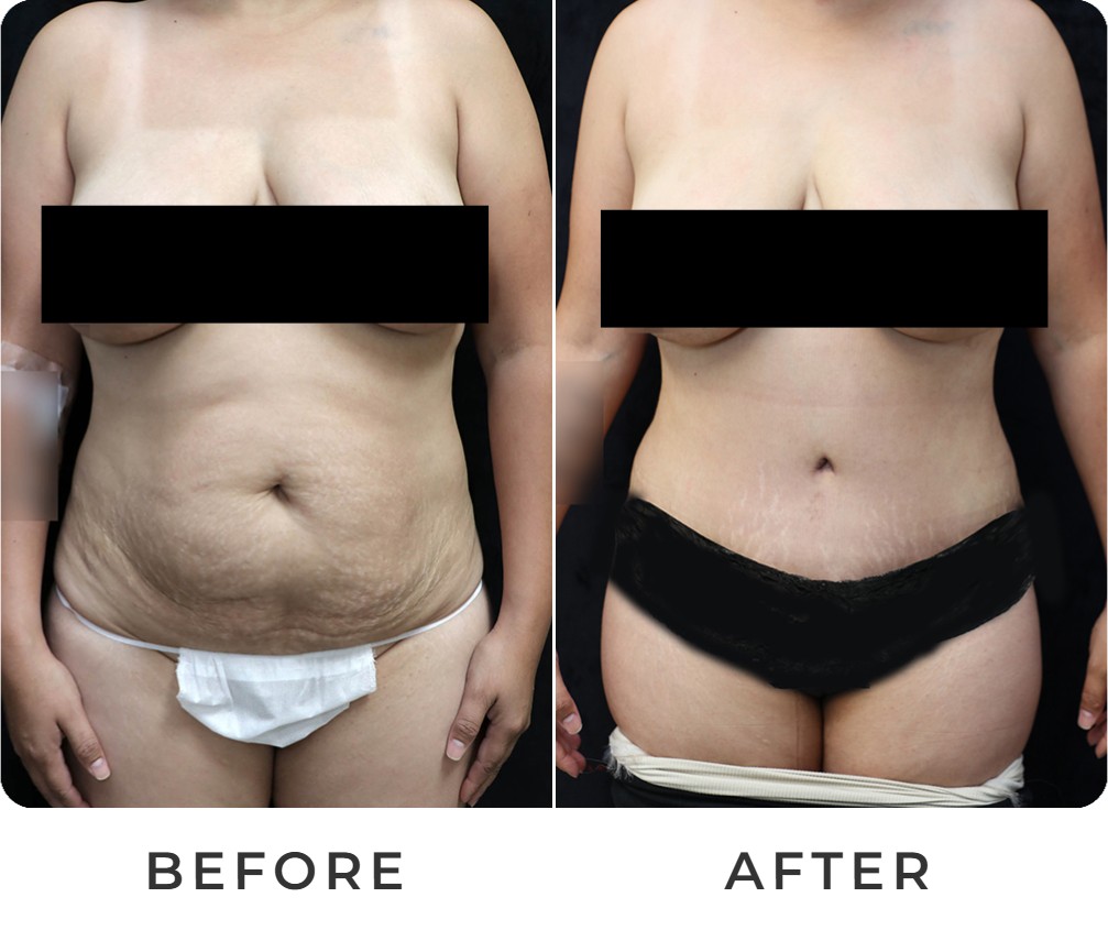 Tummy tuck before and after – Beverly Hills Physicians