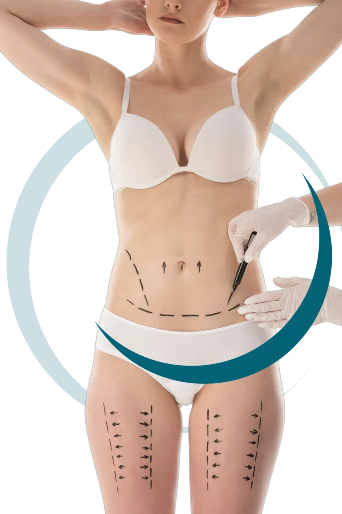 Woman with surgical marking lines before body contouring surgery