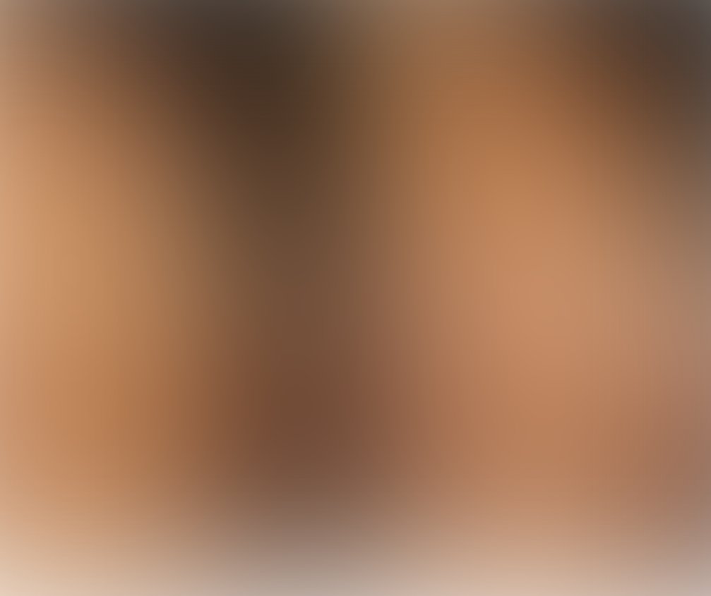 Breast augmentation before and after – Beverly Hills Physicians