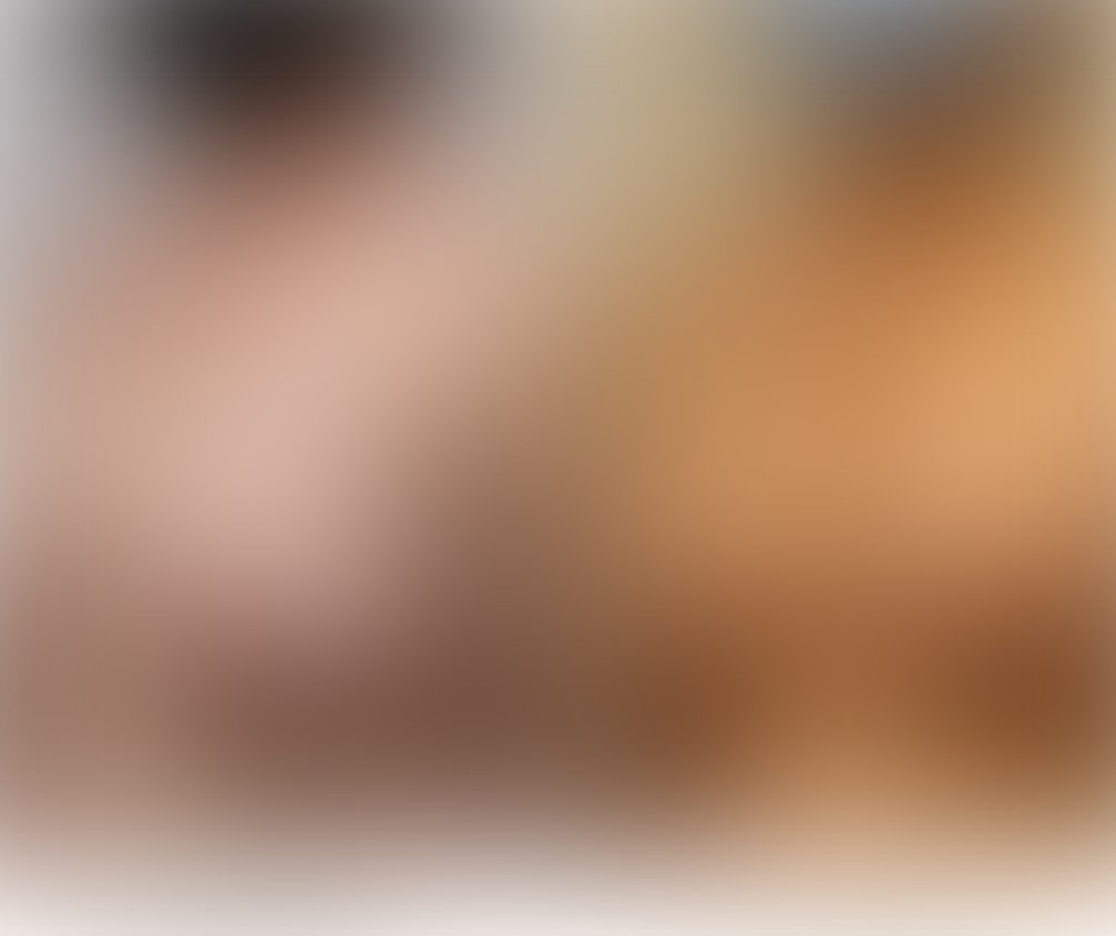 Breast reduction before and after – Beverly Hills Physicians