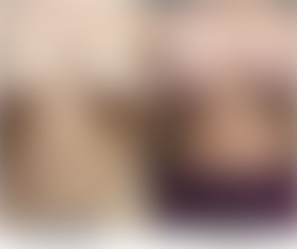 Breast reduction before and after – Beverly Hills Physicians