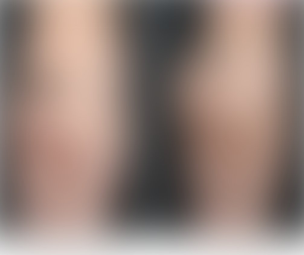 Liposuction with BBL before and after – Beverly Hills Physicians